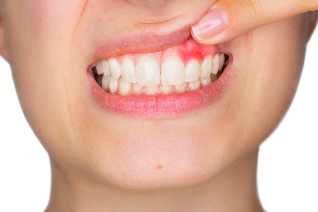 5 síntomas de unas encías enfermas |  Clínica Dental en Cartagena