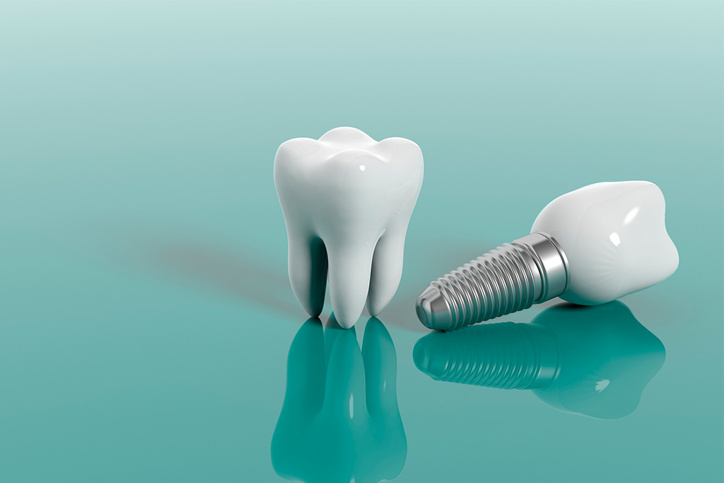 4 falsos mitos sobre los implantes dentales | Implantes Cartagena